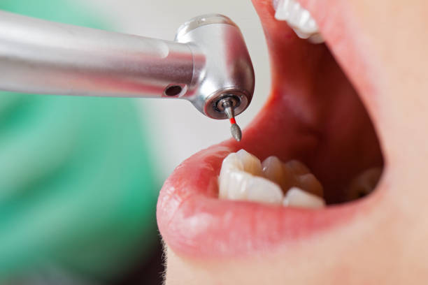 Best Emergency Root Canal Treatment in Eureka, IL